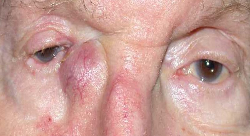 Dacryocystitis