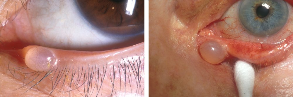 cyst-banner