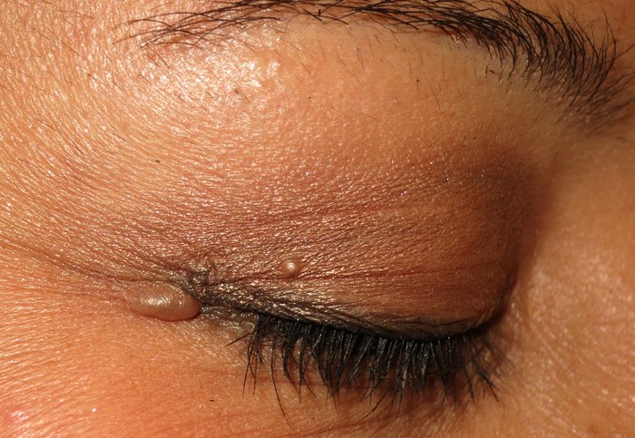 eyelid-cyst