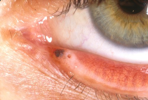 nevus-1