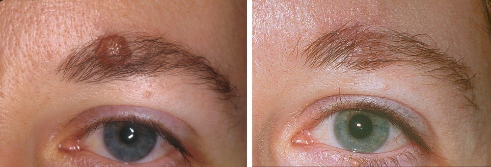 nevus-banner