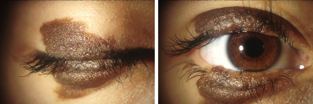 nevus-kiss-banner