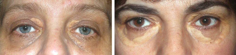 xanthelasma-banner